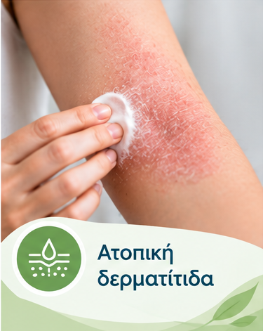 Ατοπική δερματίτιδα – Έκζεμα